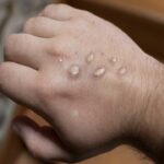 Monkeypox Danger