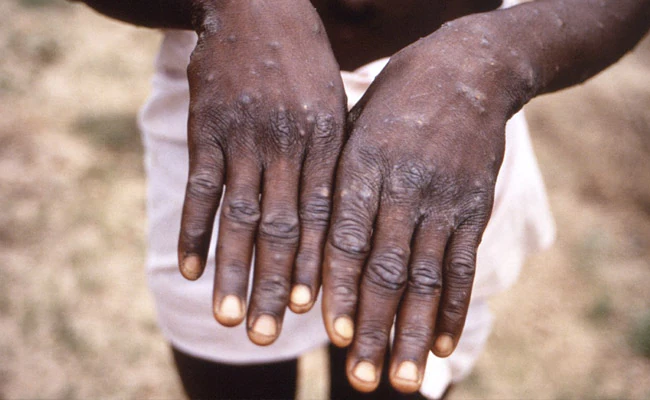 Monkeypox