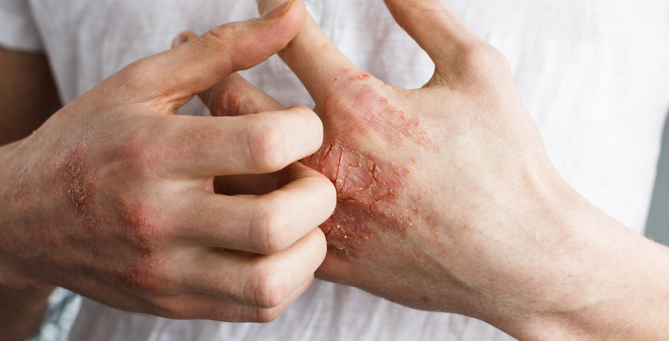 eczema treatment