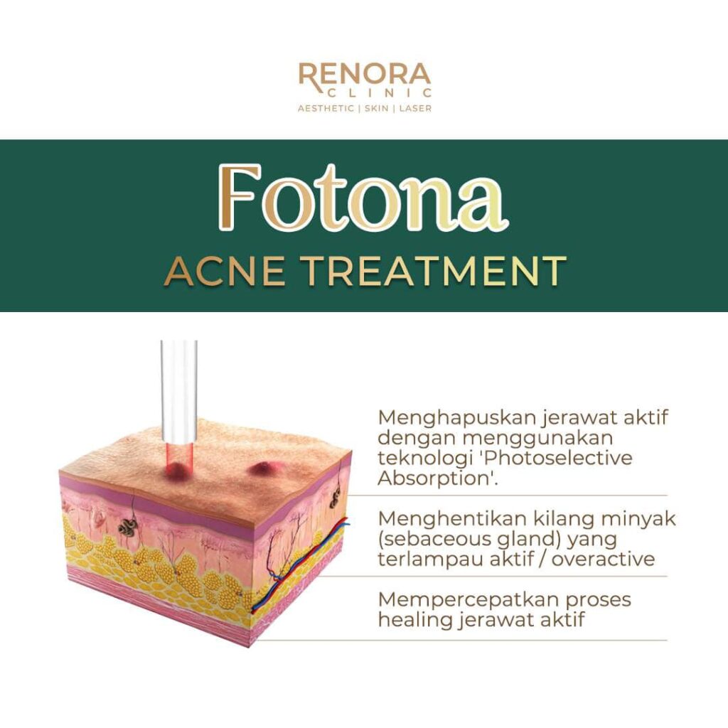 Fotona acne treatment