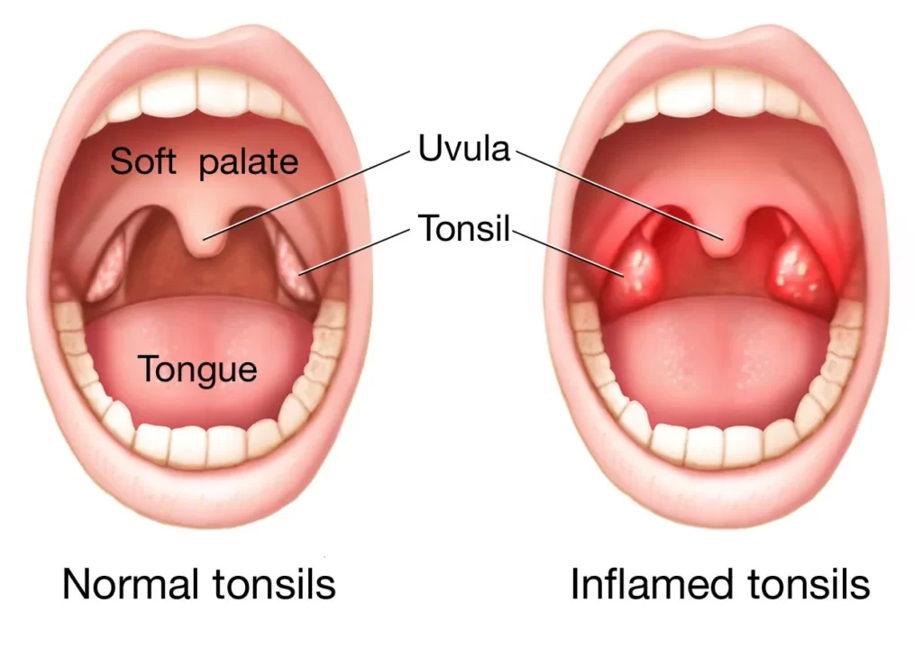 Tonsillitis symptom: What Is Tonsillitis? 