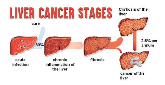 Liver Cancer Stages