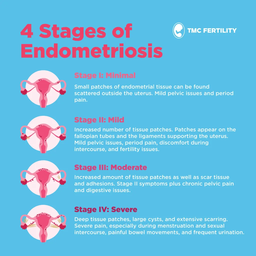 Understanding The Stages of Endometriosis