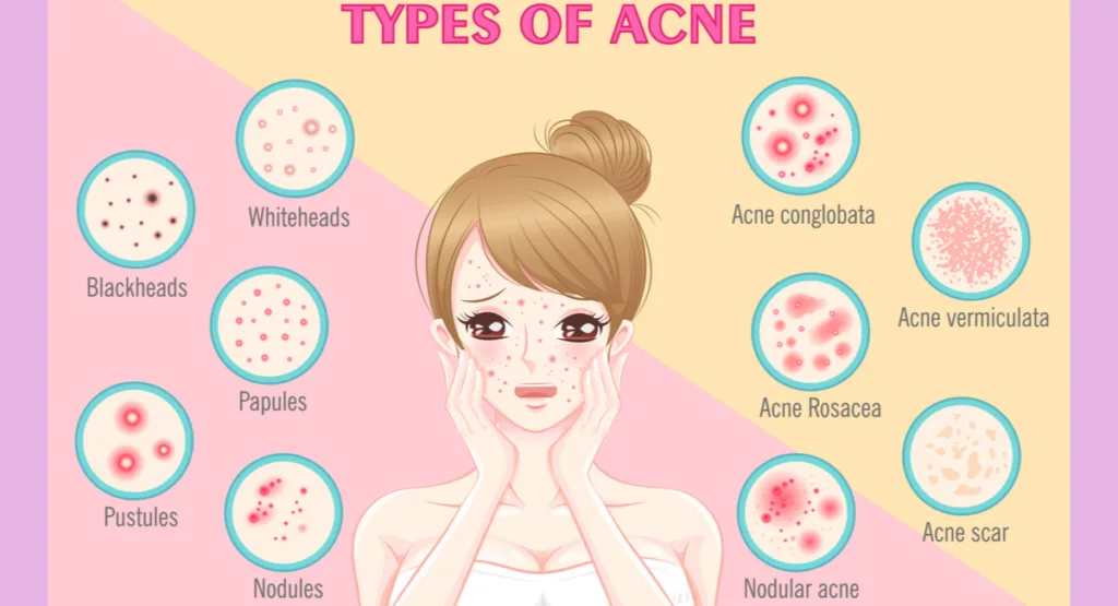 Acne & Skin Issues